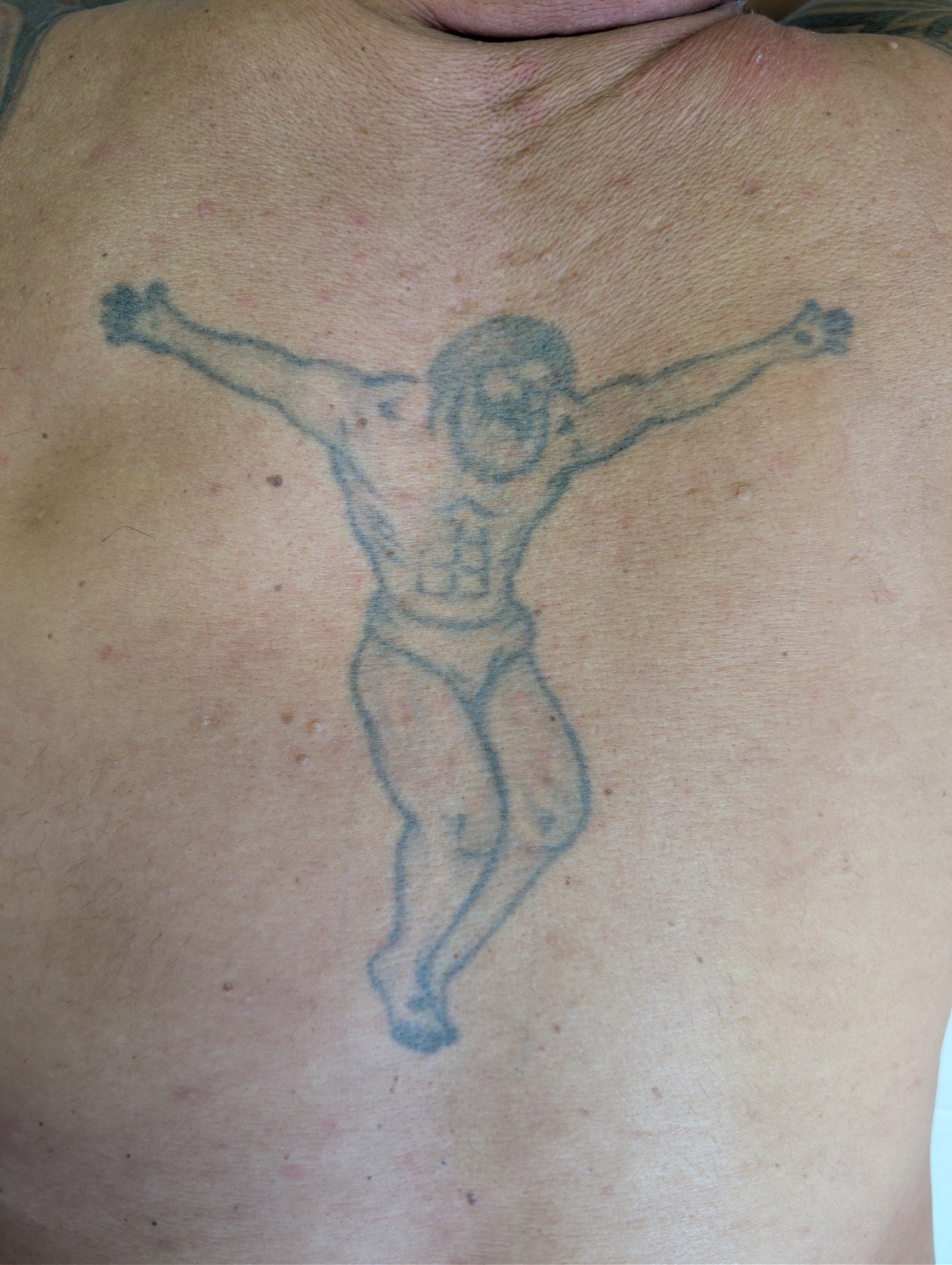 Tattoo vor Beginn der Entfernung
